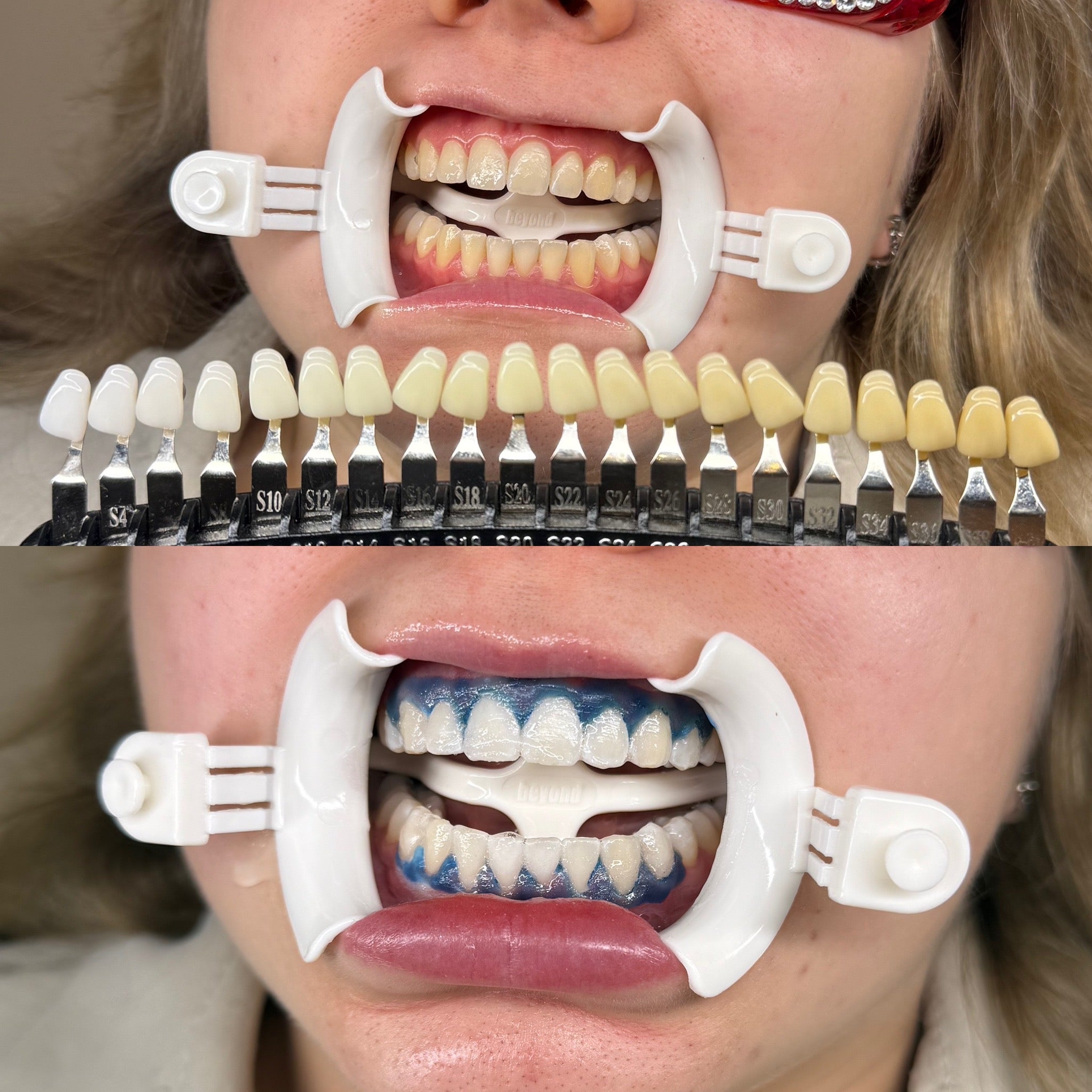 tanden bleken resultaten, professional whitening rotterdam