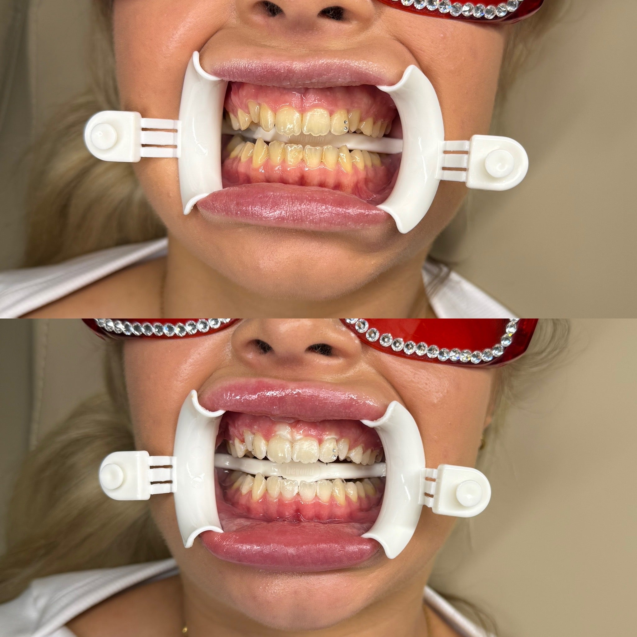 tanden bleken resultaten, professional whitening rotterdam