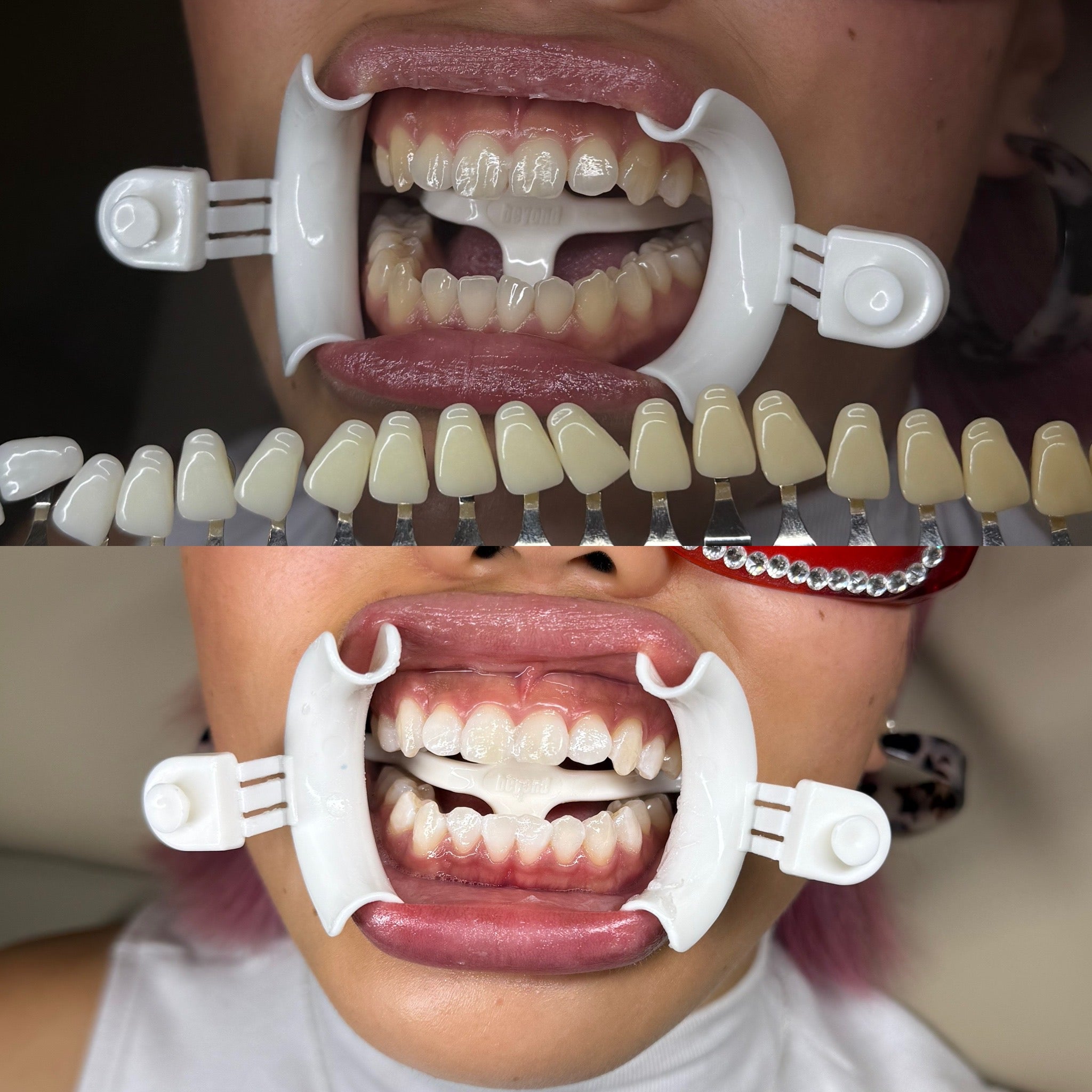 tanden bleken resultaten, professional whitening rotterdam