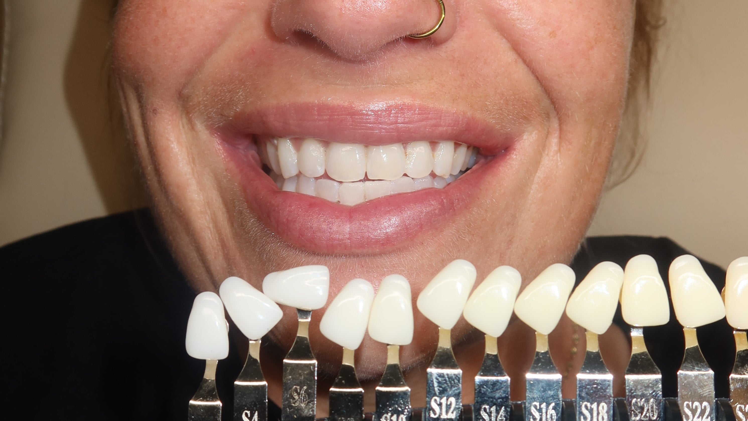 smile atelier rotterdam, luxury teeth whitening